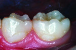 Figure 10 One year after treatment using resin-modified glass-ionomer cement.