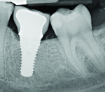 Figure 5 Radiograph of a mandibular right first molar implant in a 31-year-old woman taken 1 year after placement. No bone loss beyond physiologic remodeling has occurred; there is a
suggestion of possible cement at the distal.