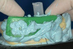 Figure 23  Disposable impression tray positionedto aid in containing the stiff PVS bite registrationmaterial.
