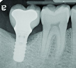 Figure 8 Radiograph taken 3 years after restoration of this mandibular right second molar implant demonstrating a peri-implant lesion.