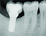 Figure 11 Radiograph taken 1 year after regenerative therapy suggests favorable bone gain covering the entire roughened surface of the dental implant.