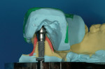 Figure 5  The PVS surgical guide with thedummy implant showing the interrelationshipbetween guide and planning.
