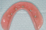 Figure 4 Interior of the mandibular denture with males for the ERA® attachment within metal
housings embedded in the denture.