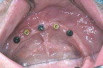 Figure 6 Mandibular arch demonstrating ERA Implants of different diameters based on ridge
width at each individual site using 3.25- and 4.1-mm implants.