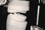 Figure 6 Mounted edentulous maxillary casts should be used in initial assessment of possible
treatment scenarios. A fifth important factor that is part of the dimensional assessment
is the restorative dimension, that is visible when casts are properly mounted.
Note the class III maxilliomandibular relationship and the limited posterior restorative
dimension that challenges this scenario.