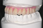 Figure 7 A diagnostic tooth arrangement further
defines the challenges and permits assessment of implant location that will not interfere
with esthetics or phonetics.