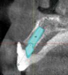 Figure 14 Crosssection
revealing the proposed placement of the implant and abutment dimension in
the posterior region (note the bone density)