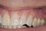 Figure 1 Preoperative view showing significant gingival recession on teeth No. 8 through
No. 14.