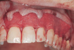 Figure 3 Graft was trimmed and sutured to the interproximal papillae with resorbable
sutures.
