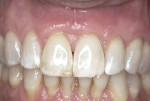 Figure 6 Esthetic, significant root
coverage at 6-month follow-up.