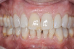 Figure 7 At 18-month follow-up, all treated teeth
demonstrated 80% to 100% root coverage and a healthy band of keratinized gingiva.