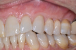 Figure 8 At 18-month follow-up, all treated teeth
demonstrated 80% to 100% root coverage and a healthy band of keratinized gingiva.