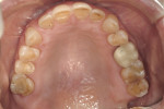 Figure 2 Maxillary arch at initial presentation; note the areas of moderate attrition and dentin displaying tooth loss from erosion.