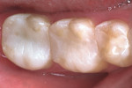 Figure 7d  Seated molar indirect in-officecomposite onlay restorations and direct premolarcomposite restoration.