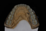 A full mandibular arch of full zirconia restorations.