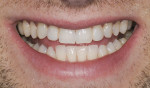 Figure 1 A 26-year old man presented with congenitally missing maxillary lateral incisors and both over-retained deciduous teeth.