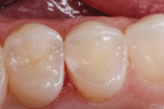 Figure 6 Occlusal view of the completed restoration. Note the palatal embrasure
and the precision of the proximal cavosurface margin with no finishing or polishing
required due to excessive flash (material).