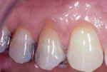 Figure 1 Preoperative image of facial gingival recession defect, tooth No. 5.