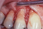 Figure 2 Full thickness
flap reflected showing facial bone loss.