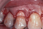 Figure 3 ADM placed over root surface and below
gingival flap.
