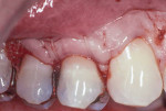 Figure 4 Gingival flap secured completely over ADM and root surface using a continuous suture.