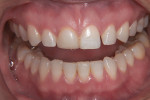 Figure 1 Pretreatment views. Patient presented with darkening of tooth No. 8,
multiple diastemas, and an uneven gingival line.