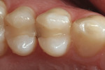 Figure 1  Preoperative occlusal view of toothNo. 5, which had recurrent caries in the lingualproximalarea of a 10-year-old composite resinrestoration.