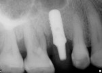 Figure 1 Preoperative periapical radiograph
showing advanced periodontal bone loss
and furcation involvement on upper right
first molar.