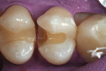Figure 2  After isolation, the defective restorationwas removed, and the preparation was modifiedto remove the recurrent caries. Note theovercontouring of the composite restoration intooth No. 4 and how this helped to create a concavityin the distopr