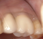 Figure 6 Mirror view of restored replacement
implant with buccal fistula draining near the mucogingival junction.
