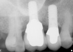 Figure 10 Periapical radiograph 1 year following
REC removal showing intact crestal
bone levels and a lack of radiopaque material
on the abutment.