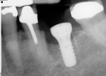 Figure 11 Periapical radiograph taken 4 weeks following implant placement.