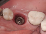 Figure 14 Clinical view after removal of the custom abutment showing inflamed peri-implant mucosa.