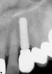 Figure 19 Radiograph taken 9 months following restoration placement with two threads of crestal bone loss, but no radiographic evidence of excess cement.