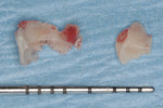 Figure 22 Cement removed from around the implant, with bevel of the top of the implant visible.