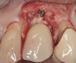 Figure 21 Initial flap reflection showing ring of cement adjacent to zirconia custom abutment.
