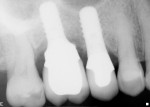 Figure 7 Radiograph taken at appointment when
fistula was observed. Note radiopaque material
on mesial apical to the implant–abutment
interface.