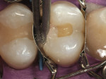 Figure 7  A desensitizer was placed to rewetthe enamel and dentin surfaces and gain initialpenetration of HEMA and fluoride into the dentinaltubules to aid in formation of the hybridzone.