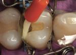 Figure 8  A fifth-generation adhesive(OptiBond Solo Plus) was applied copiously tothe enamel and dentinal surfaces.