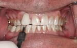 Figure 4 Post-study view of Subject #2 showing dramatic improvement in tooth color.