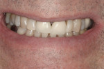 Figure 6 Post-whitening full smile view of Subject #9 showing how the whitening allowed the patient’s existing PFM crowns to now blend better with his natural teeth.
