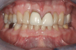 Figure 5 Retracted pre-whitening photograph of Subject #9 with shade A4 adjacent to old, opaque A1/B1 PFM crowns.