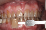 Figure 3 Subject #2 presented with a severe tooth discoloration on anterior maxillary teeth and pre-whitening tooth shades of A4. The 5M2 shade tab is the equivalent of an A4 in the VITA Classic guide.
