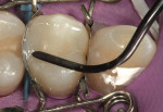 Figure 14  The FlexiThin Mini 4 was used to sculptthe lingual (palatal) surface of the restoration.