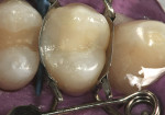 Figure 16  Occlusal view of the completedrestoration before removal of the matrix and finishingprocedures were performed.