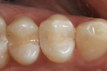 Figure 18  Occlusal view of the completed restorationafter light-curing of the surface sealant.