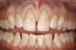 Figure 1  Preoperative presentation of a patient exhibiting multiple adjacent gingivalrecession defects ranging from teeth Nos. 8 through 14. Notice that with a diastema present, elevatingthe midline papilla would have created additional risk of furt