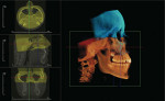 Figure 5  Examples of InVivoDental applications presently under development in which adjacent CBCTimage volumes can be stitched together to provide a larger effective FOV. The cranium is stitchedto the maxillofacial structures using two overlapping N