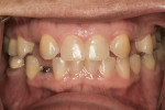 Figure 1 Preoperative view showing bilateral retained deciduous canine teeth, congenitally missing permanent maxillary lateral incisors, and permanent canine teeth anteriorly positioned toward the central incisors. Mesial-distal widths in the right and left canine areas were 8.5 and 10 mm, respectively.