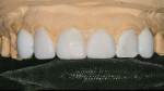 Figure 2 Diagnostic wax mock-up to determine the spatial relationships of the final restorations and how to prepare the involved teeth.